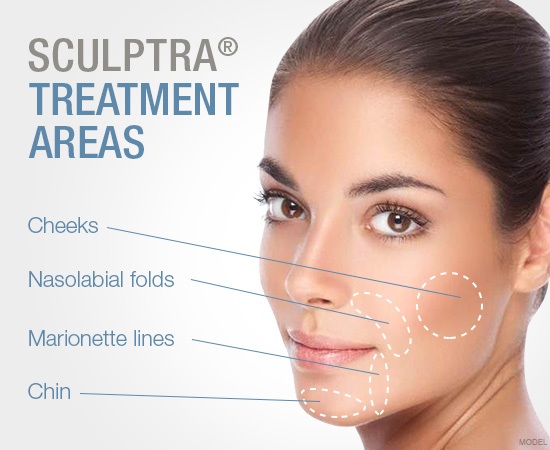 Sculptra Cosmetic Injections in Montreal